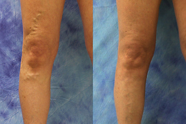 Varicose vein laser treatment before and after results on a 50-year-old female patient