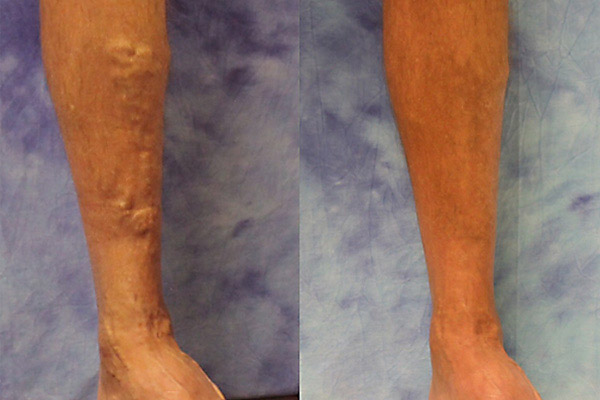 Surface sclerotherapy treatment results for prominent bulging veins on a 59-year-old male patient