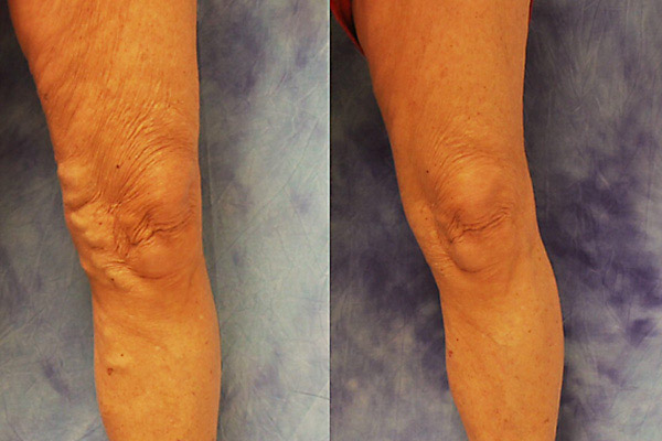 Endovenous laser ablation results on a 72-year-old female patient