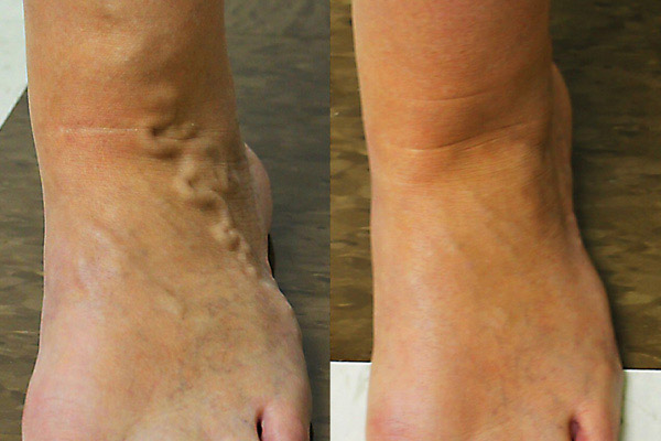 Pregnancy induced varicose vein recovery metrics on a 45-year-old female patient