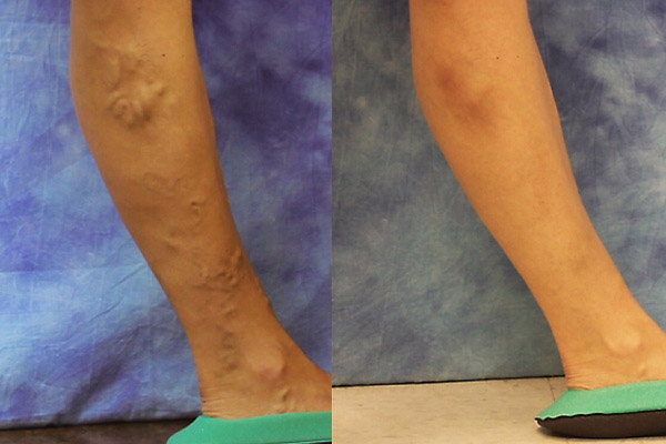 Ultrasound guided sclerotherapy before and after results on a 50-year-old female patient