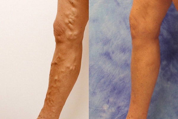 Advanced venous disease and leg ulcer recovery results on a 56-year-old female patient