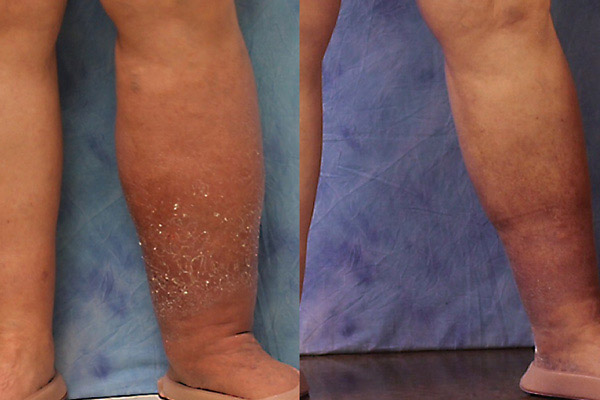 Milroy disease edema reduction results via thermal laser care on a 70-year-old male patient