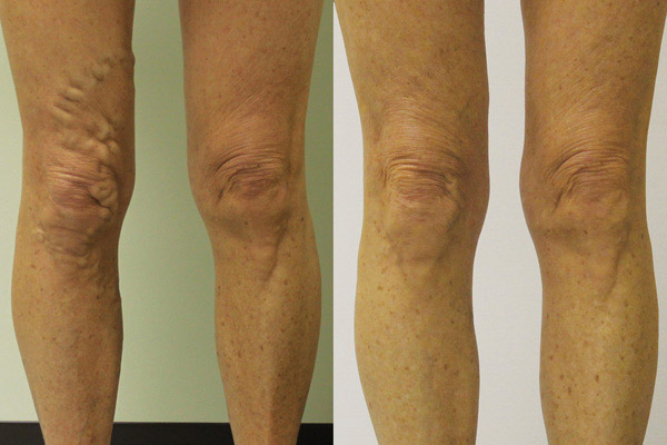 Bilateral varicose vein laser treatment map on a 65-year-old female patient